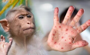 Piura: reportan segundo caso de viruela del mono en Veintiséis de Octubre